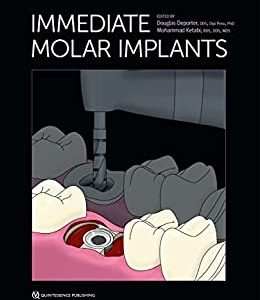 Immediate Molar Implants (Original PDF from Publisher)
