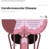 CONTINUUM Lifelong Learning in Neurology April 2023, Volume 29, Issue 2 (True PDF)