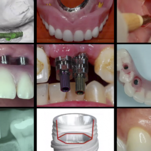 Gidedental A-Z in Restorative Implant Dentistry (Videos)