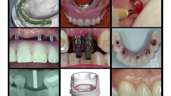 Gidedental A-Z in Restorative Implant Dentistry (Videos)