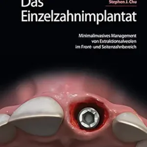 Das Einzelzahnimplantat: Minimalinvasives Management von Extraktionsalveolen im Front- und Seitenzahnbereich (German Edition) (EPUB)