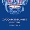 Zygoma Implants: Step by Step (Original PDF from Publisher)