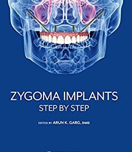 Zygoma Implants: Step by Step (Original PDF from Publisher)