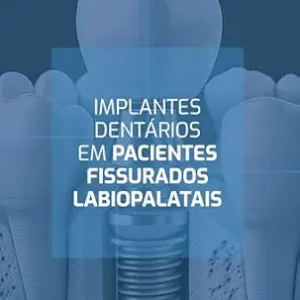 Implantes dentários em pacientes fissurados labiopalatais (Portuguese Edition) (EPUB)