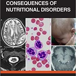 Neurological Consequences of Nutritional Disorders (Original PDF from Publisher)