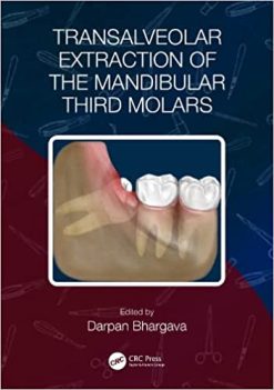Transalveolar Extraction of the Mandibular Third Molars (Original PDF from Publisher)