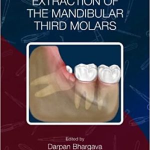 Transalveolar Extraction of the Mandibular Third Molars (Original PDF from Publisher)
