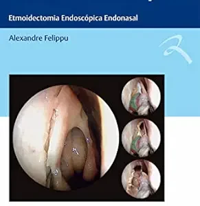 Técnica Centrípeta: Etmoidectomia Endoscópica Endonasal (Portuguese Edition) (EPUB)