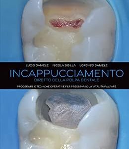 Incappucciamento diretto della polpa dentale: Procedure e tecniche operative per preservare la vitalità pulpare (EPUB)