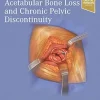 Treatment of Acetabular Bone Loss and Chronic Pelvic Discontinuity (EPUB)