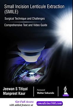 Small Incision Lenticule Extraction (SMILE): Surgical Technique and Challenges (Comprehensive Text and Video Guide) (Original PDF from Publisher)