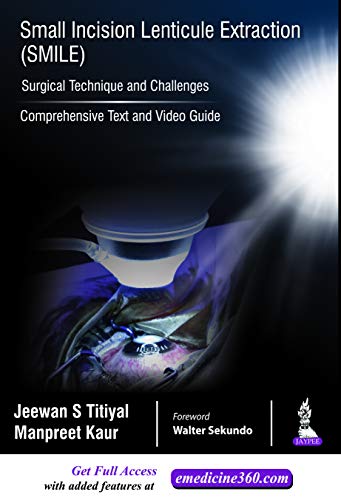 Small Incision Lenticule Extraction (SMILE): Surgical Technique and Challenges (Comprehensive Text and Video Guide) (Original PDF from Publisher)