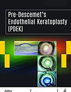 Pre-Descemet’s Endothelial Keratoplasty (PDEK) (Original PDF from Publisher+Videos)