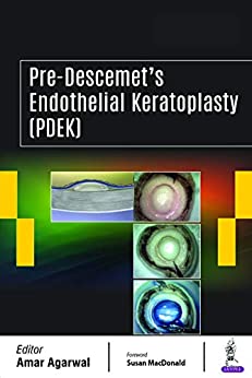 Pre-Descemet’s Endothelial Keratoplasty (PDEK) (Original PDF from Publisher+Videos)