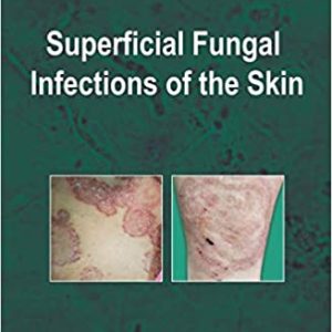 Superficial Fungal Infections of the Skin (Original PDF from Publisher)