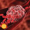 Thrombosis & Thromboembolism 2022 (Videos)