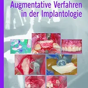 Augmentative Verfahren in der Implantologie (German Edition) (EPUB)