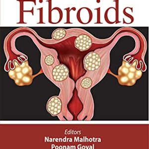 Fibroids (Original PDF from Publisher)