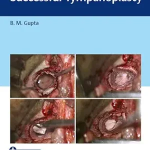 An Approach to Successful Tympanoplasty (Original PDF from Publisher+Videos)