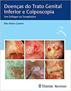 Doenças do Trato Genital Inferior e Colposcopia: Um Enfoque na Terapêutica (Original PDF from Publisher)