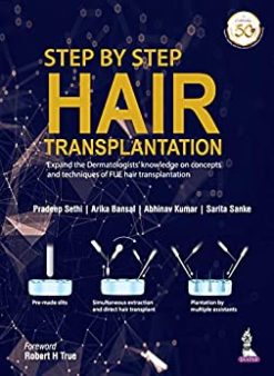Step by Step Hair Transplantation (Original PDF from Publisher)