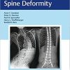 Neuromuscular Spine Deformity 1st Edition (Original PDF from Publisher)