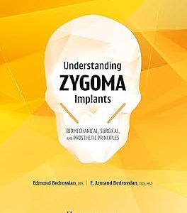 Understanding Zygoma Implants: Biomechanical, Surgical, and Prosthetic Principles (Original PDF from Publisher)