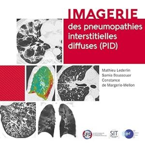 Imagerie des pneumopathies interstitielles diffuses (PID) (French Edition) (Original PDF from Publisher)