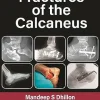 Fractures of the Calcaneus, 2nd Edition (Original PDF from Publisher)