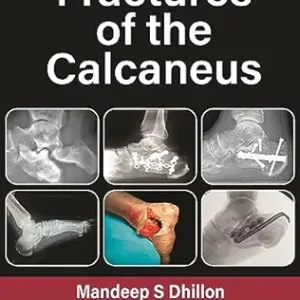 Fractures of the Calcaneus, 2nd Edition (Original PDF from Publisher)