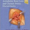 Treatment of Acetabular Bone Loss and Chronic Pelvic Discontinuity (True PDF)