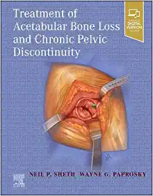 Treatment of Acetabular Bone Loss and Chronic Pelvic Discontinuity (True PDF)