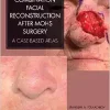 Combination Facial Reconstruction after Mohs Surgery: A Case Based Atlas (Original PDF from Publisher)