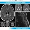 Pediatric Collections: Neurology Cases: Case Reports from Pediatrics in Review (Original PDF from Publisher)