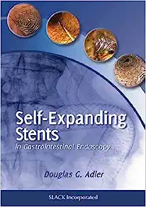 Self-Expanding Stents in Gastrointestinal Endoscopy (Original PDF from Publisher)