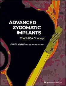 Advanced Zygomatic Implants: The ZAGA Concept (Original PDF from Publisher)