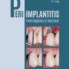 Peri-Implantitis: From Diagnosis to Treatment (EPUB)