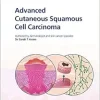 Advanced Cutaneous Squamous Cell Carcinoma for Patients and Their Supporters: Information + Taking Control = Best Outcome (Fast Facts) (EPUB)