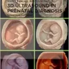 3D Ultrasound in Prenatal Diagnosis: A Practical Approach, 2nd edition (Original PDF from Publisher)