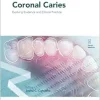 Coronal Caries (Monographs In Oral Science, 31) (EPUB)