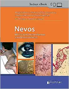 Nevos, Tumores Neviformes y Síndromes Névicos (Spanish Edition) (High Quality Image PDF)