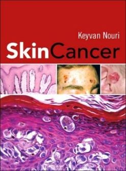 Skin Cancer
