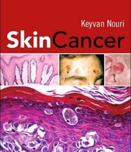 Skin Cancer