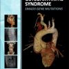 Aneurysms-Osteoarthritis Syndrome: SMAD3 Gene Mutations (Original PDF from Publisher)