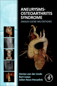 Aneurysms-Osteoarthritis Syndrome: SMAD3 Gene Mutations (Original PDF from Publisher)