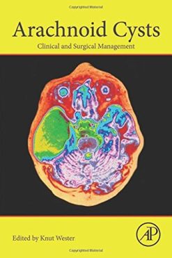 Arachnoid Cysts: Clinical and Surgical Management (PDF)