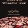 Cerebral Dural Arteriovenous Fistulas (Original PDF from Publisher)