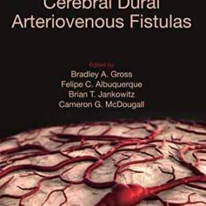 Cerebral Dural Arteriovenous Fistulas (Original PDF from Publisher)