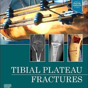 Tibial Plateau Fractures (EPUB + Converted PDF)