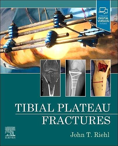 Tibial Plateau Fractures (EPUB + Converted PDF)